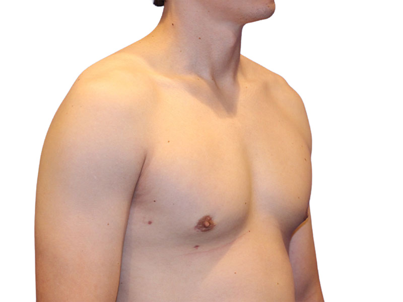 Male Breast Reduction Before and After | PERK Plastic Surgery