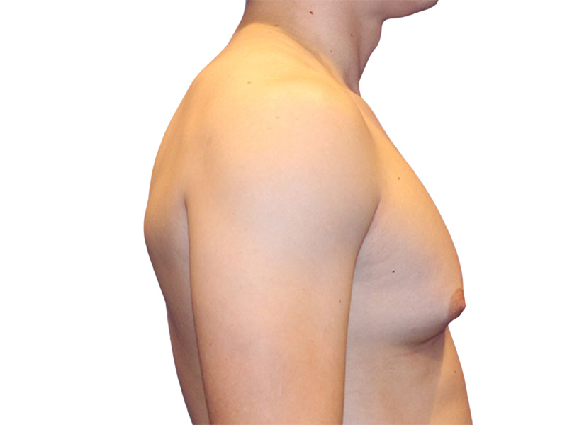 Male Breast Reduction Before and After | PERK Plastic Surgery