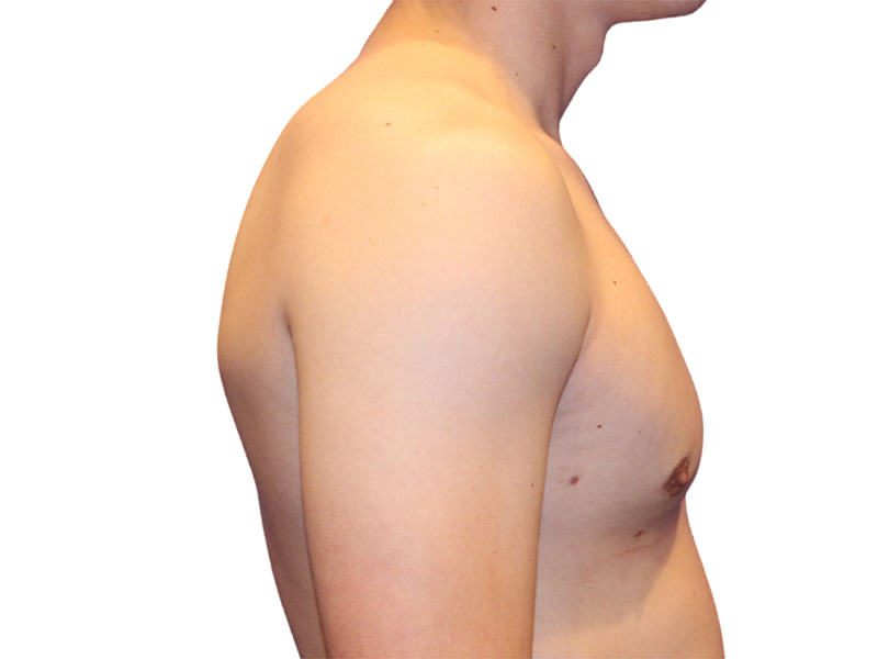 Male Breast Reduction Before and After | PERK Plastic Surgery
