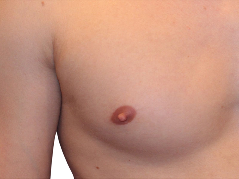 Male Breast Reduction Before and After | PERK Plastic Surgery