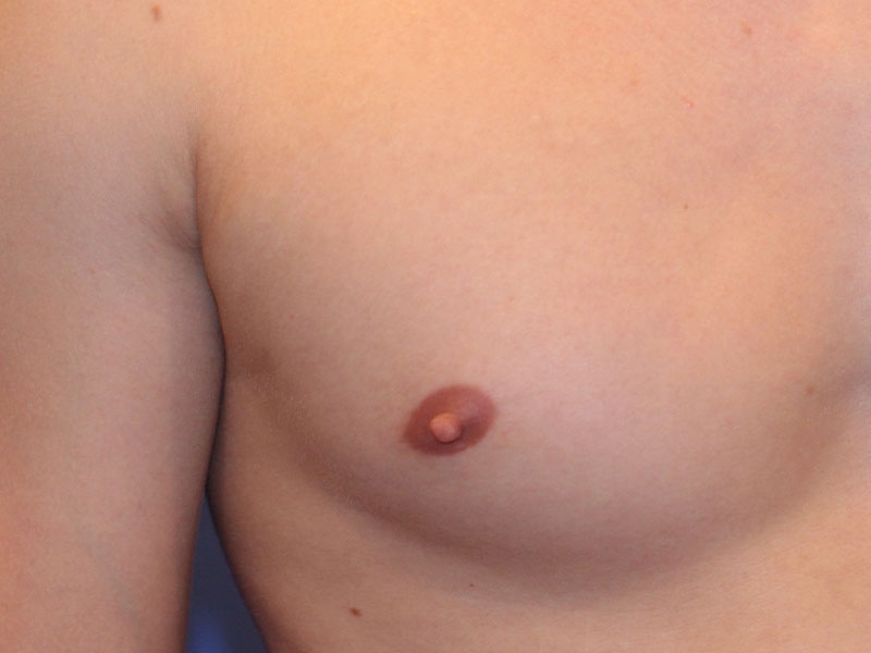 Nipple Surgery Before and After | PERK Plastic Surgery