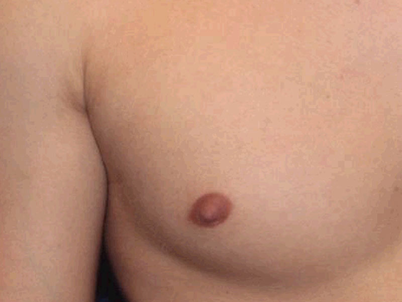 Nipple Surgery Before and After | PERK Plastic Surgery