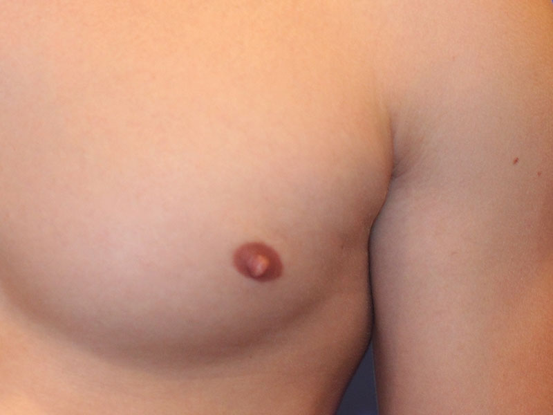 Nipple Surgery Before and After | PERK Plastic Surgery