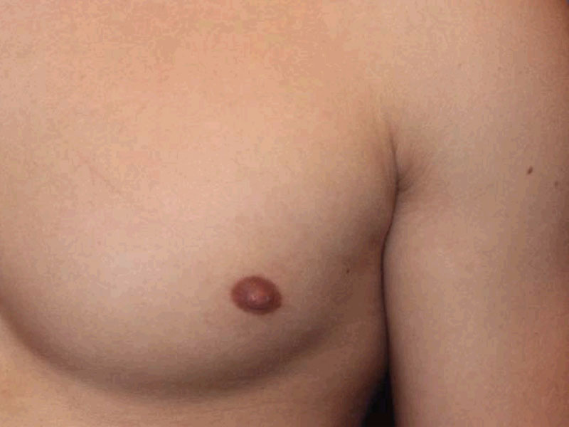 Nipple Surgery Before and After | PERK Plastic Surgery