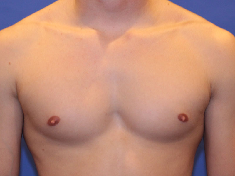 Nipple Surgery Before and After | PERK Plastic Surgery