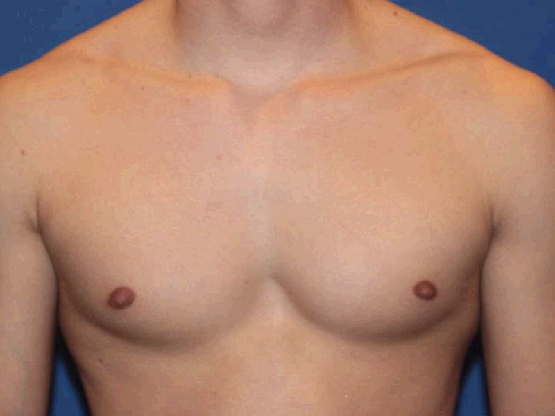 Nipple Surgery Before and After | PERK Plastic Surgery