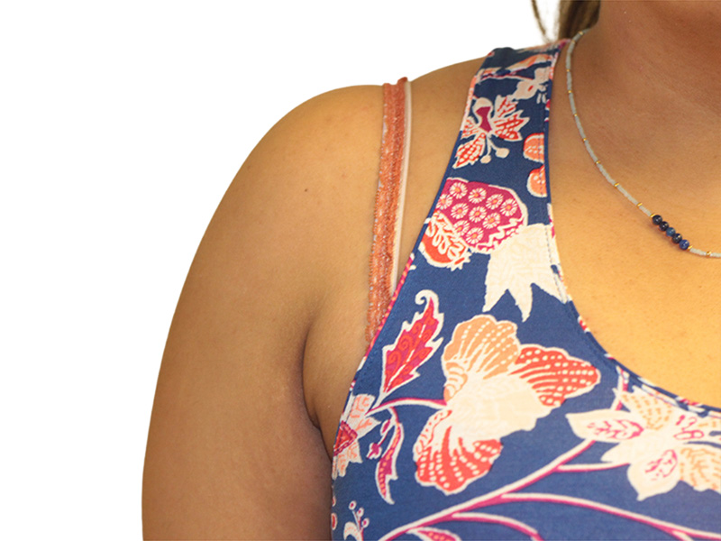 Side Breast Tissue Removal Before and After | PERK Plastic Surgery