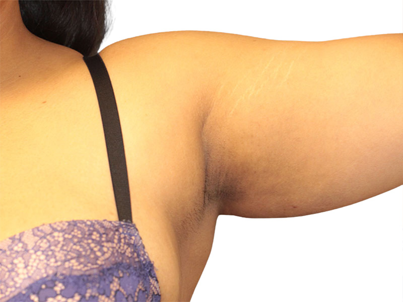 Side Breast Tissue Removal Before and After | PERK Plastic Surgery