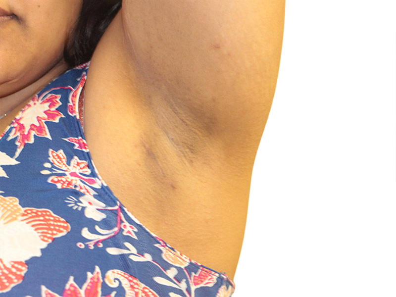 Side Breast Tissue Removal Before and After | PERK Plastic Surgery