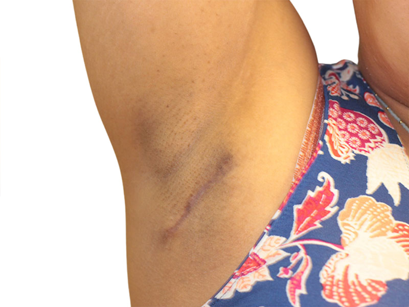 Side Breast Tissue Removal Before and After | PERK Plastic Surgery