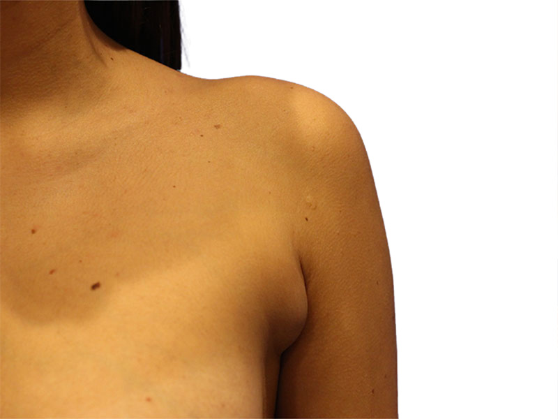 Side Breast Tissue Removal Before and After | PERK Plastic Surgery