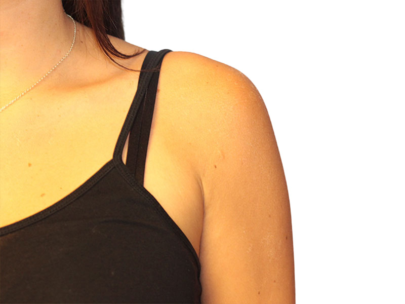 Side Breast Tissue Removal Before and After | PERK Plastic Surgery