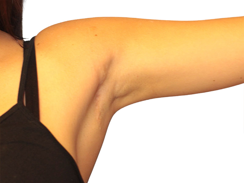 Side Breast Tissue Removal Before and After | PERK Plastic Surgery
