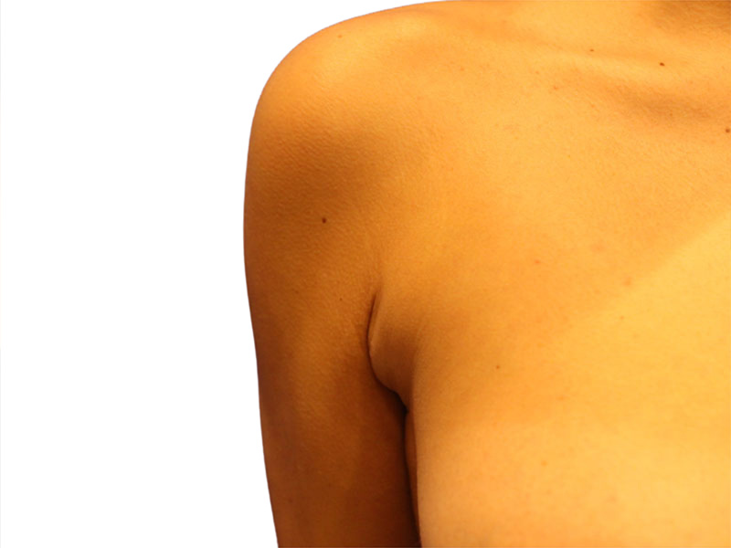 Side Breast Tissue Removal Before and After | PERK Plastic Surgery