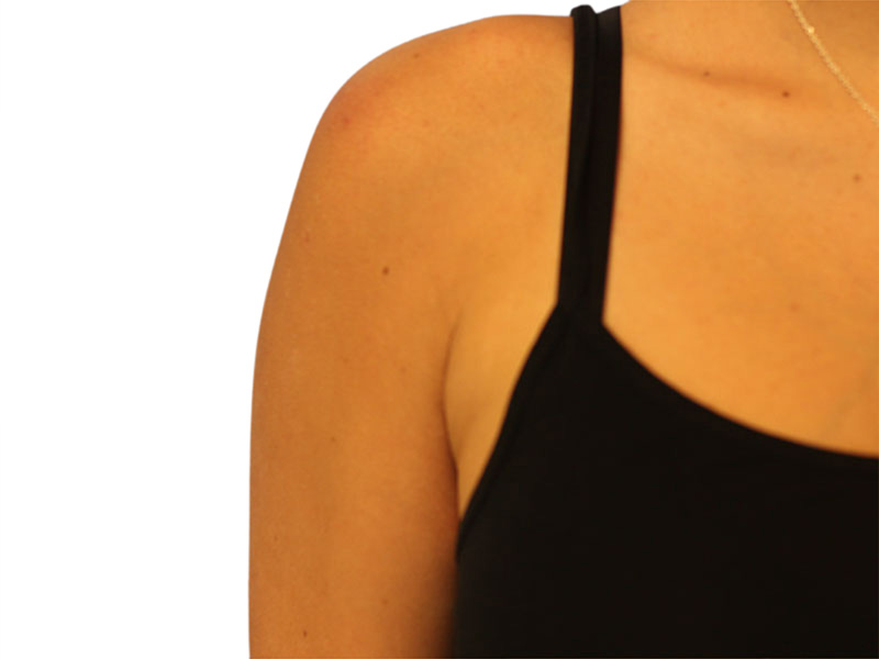 Side Breast Tissue Removal Before and After | PERK Plastic Surgery