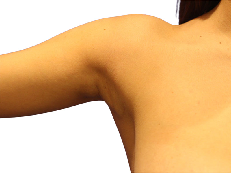 Side Breast Tissue Removal Before and After | PERK Plastic Surgery