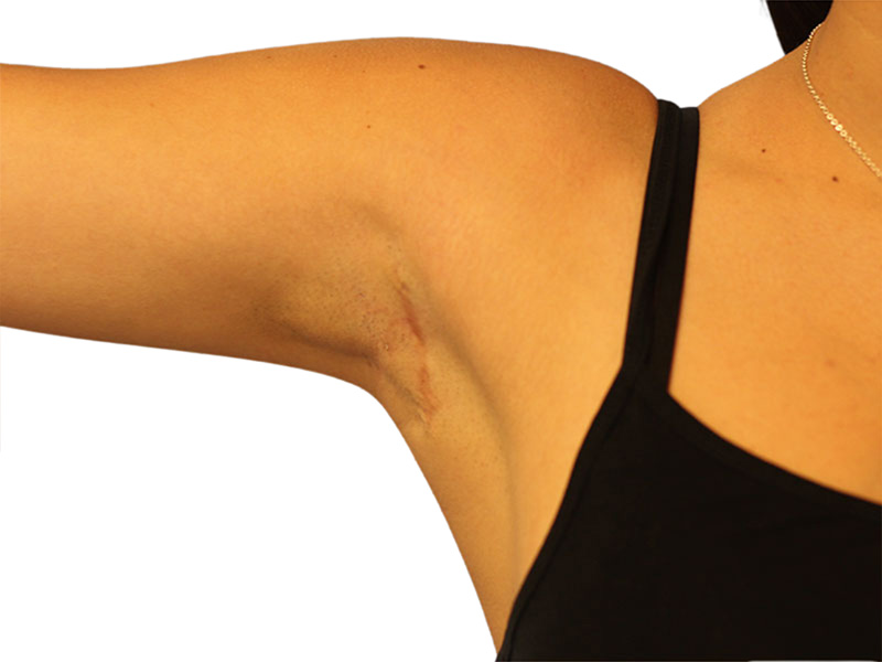 Side Breast Tissue Removal Before and After | PERK Plastic Surgery