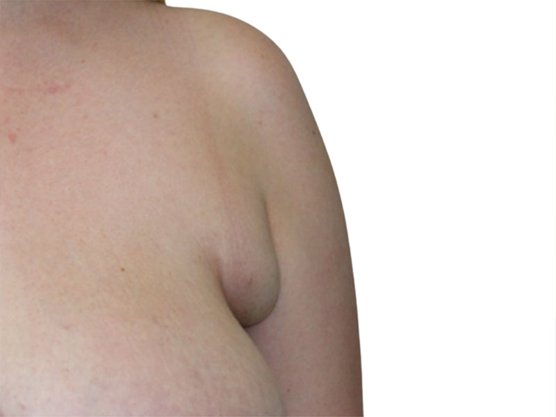 Side Breast Tissue Removal Before and After | PERK Plastic Surgery