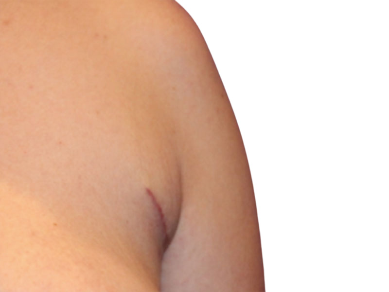 Side Breast Tissue Removal Before and After | PERK Plastic Surgery