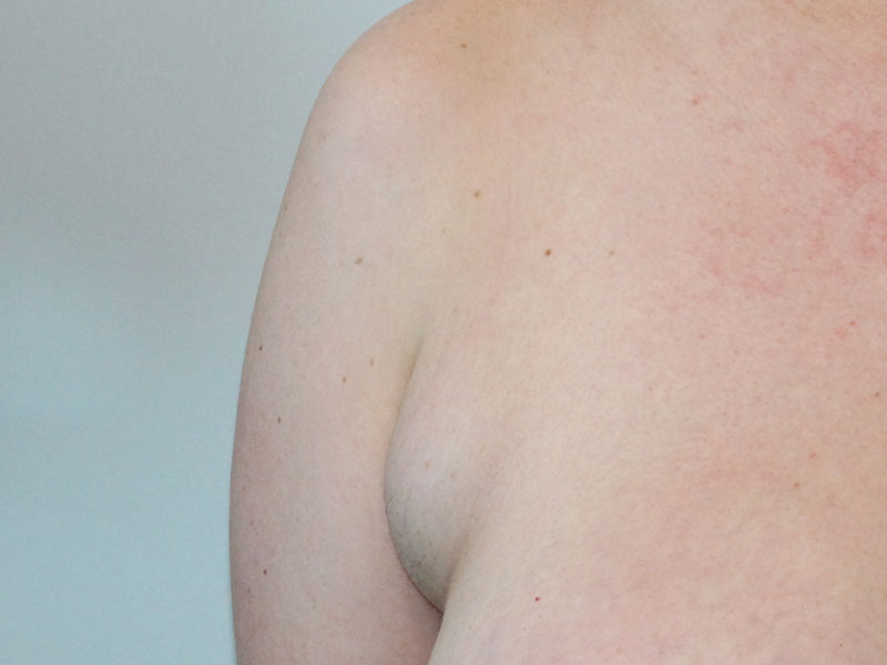 Side Breast Tissue Removal Before and After | PERK Plastic Surgery