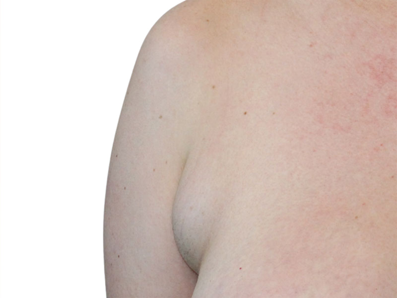 Side Breast Tissue Removal Before and After | PERK Plastic Surgery