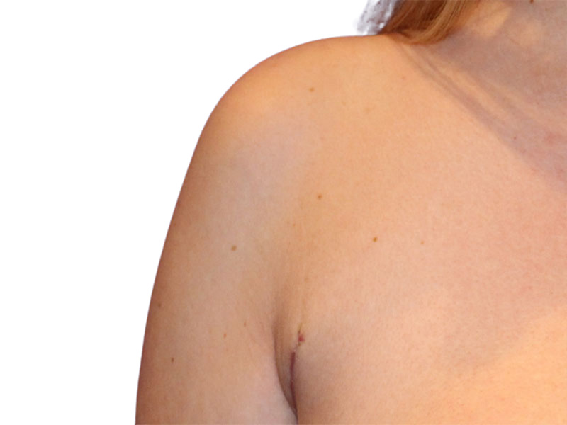 Side Breast Tissue Removal Before and After | PERK Plastic Surgery