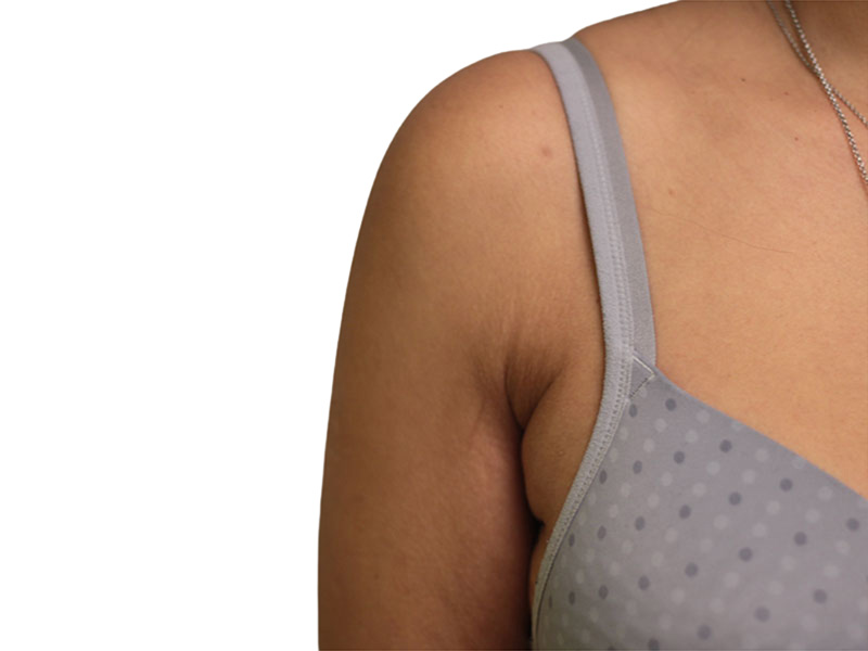 Side Breast Tissue Removal Before and After | PERK Plastic Surgery