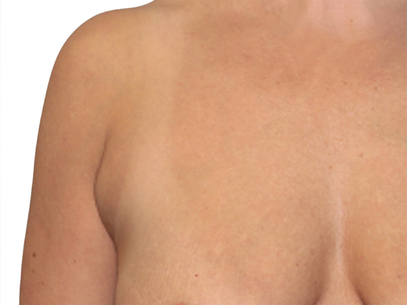 Side Breast Tissue Removal Before and After | PERK Plastic Surgery