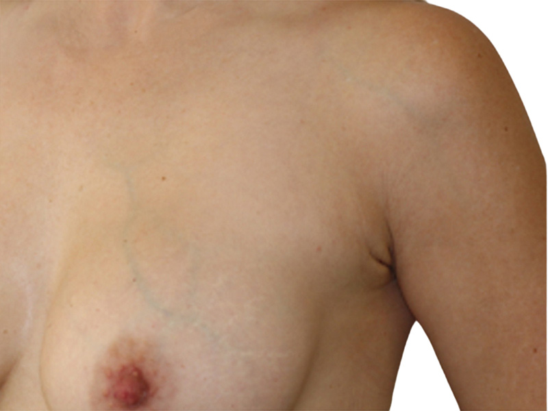 Side Breast Tissue Removal Before and After | PERK Plastic Surgery