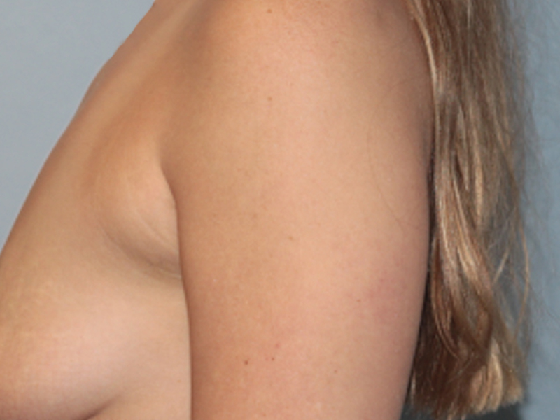 Side Breast Tissue Removal Before and After | PERK Plastic Surgery