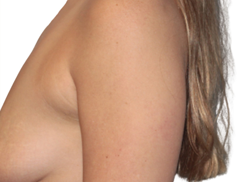 Side Breast Tissue Removal Before and After | PERK Plastic Surgery
