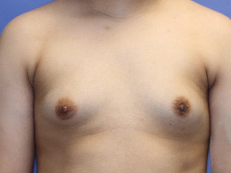 Top Surgery Before and After | PERK Plastic Surgery