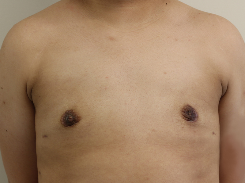 Top Surgery Before and After | PERK Plastic Surgery