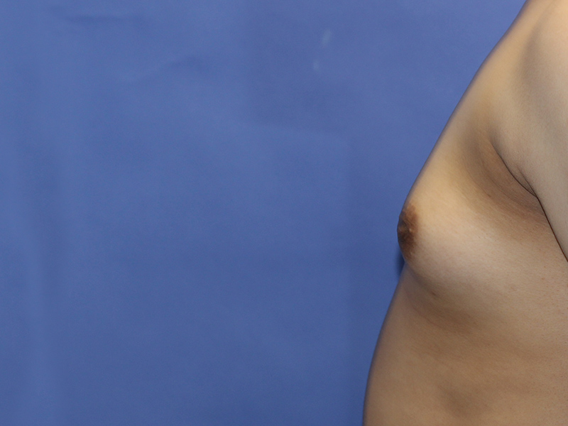Top Surgery Before and After | PERK Plastic Surgery