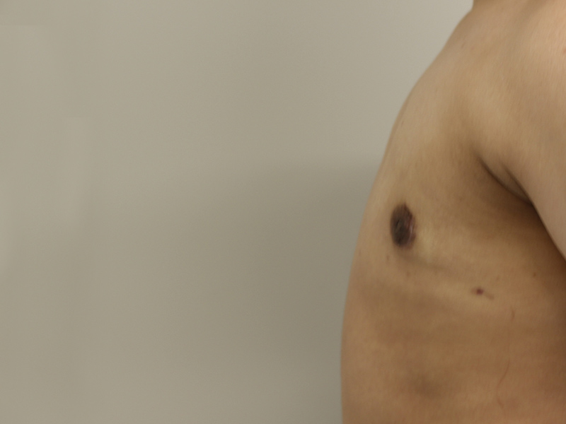 Top Surgery Before and After | PERK Plastic Surgery