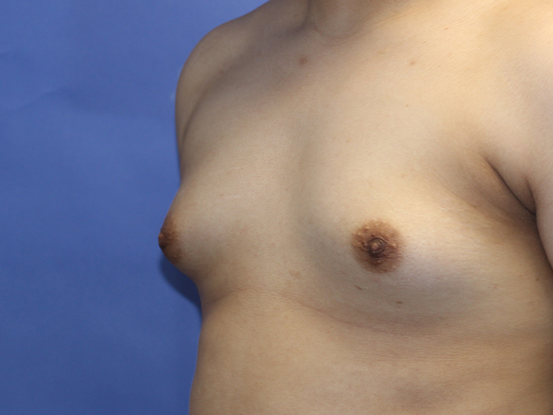 Top Surgery Before and After | PERK Plastic Surgery