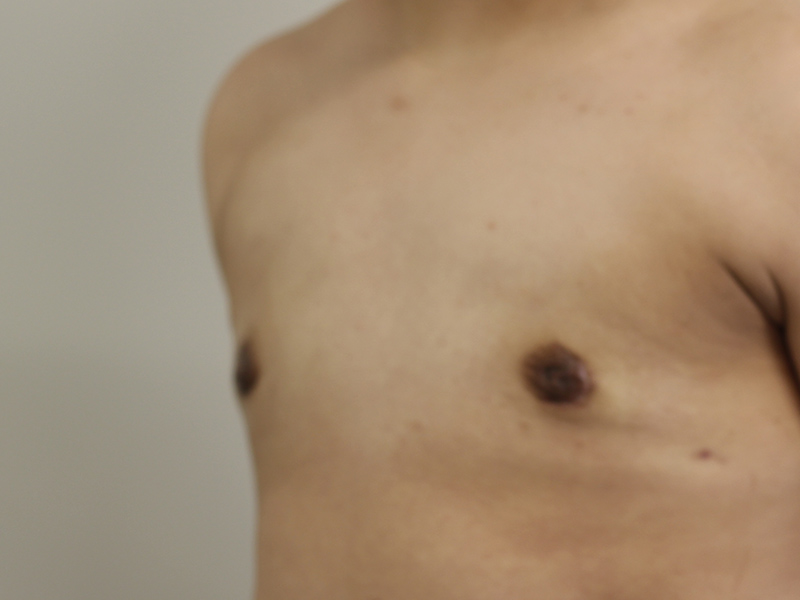 Top Surgery Before and After | PERK Plastic Surgery