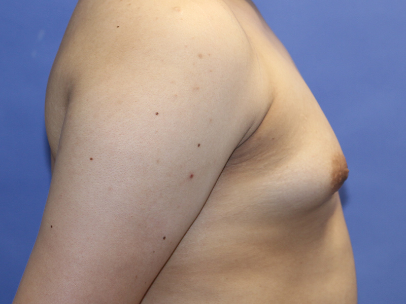 Top Surgery Before and After | PERK Plastic Surgery