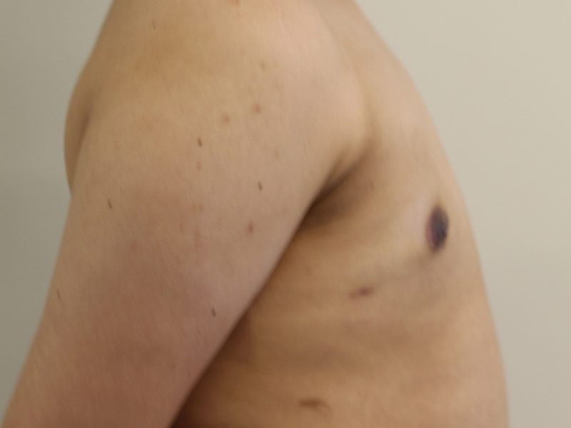 Top Surgery Before and After | PERK Plastic Surgery