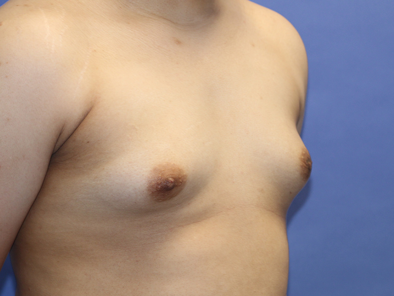 Top Surgery Before and After | PERK Plastic Surgery