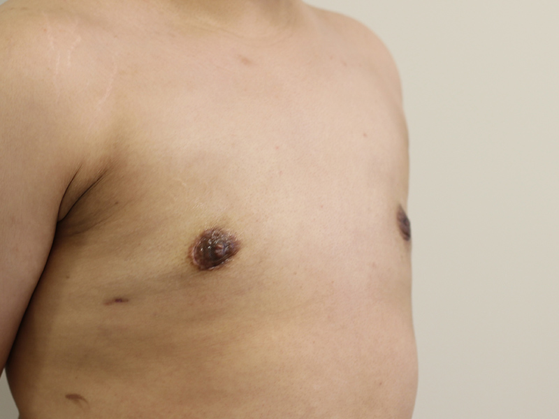 Top Surgery Before and After | PERK Plastic Surgery