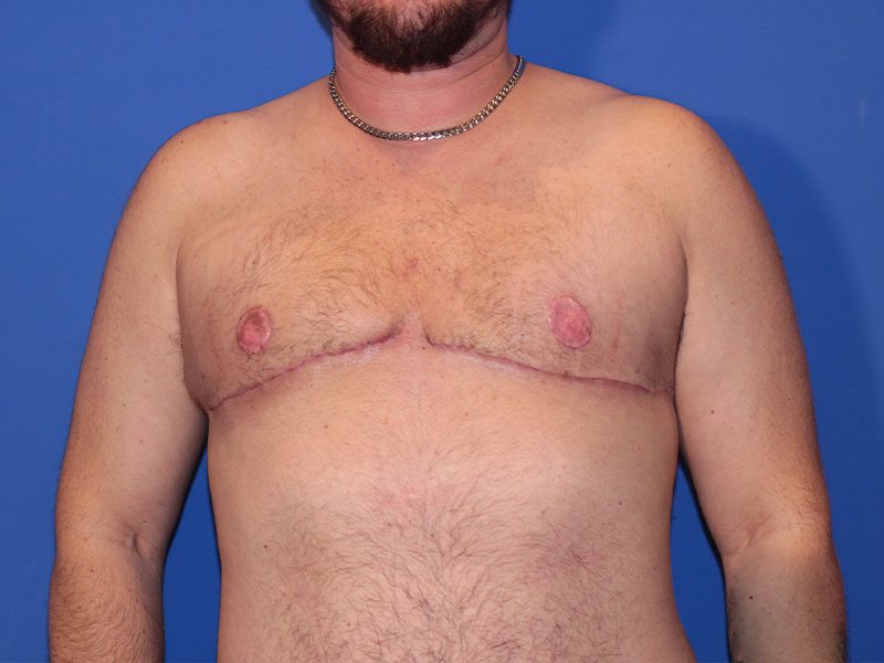 Top Surgery Before and After | PERK Plastic Surgery