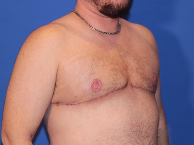 Top Surgery Before and After | PERK Plastic Surgery