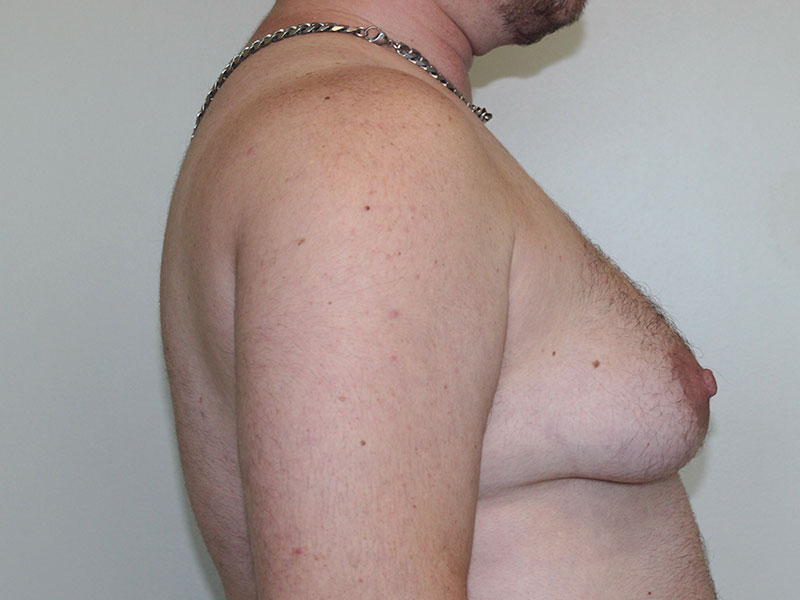 Top Surgery Before and After | PERK Plastic Surgery