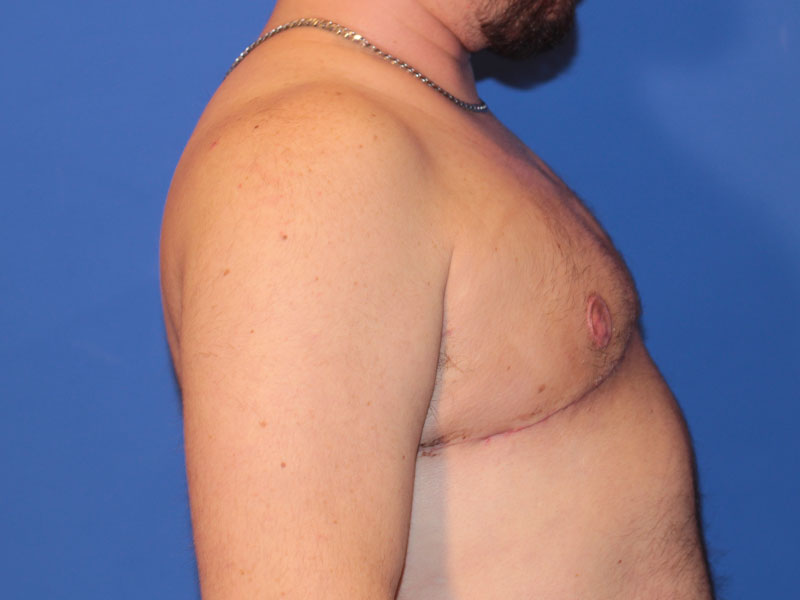 Top Surgery Before and After | PERK Plastic Surgery