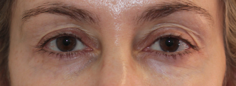 Blepharoplasty Before and After | PERK Plastic Surgery