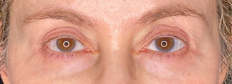Blepharoplasty Before and After | PERK Plastic Surgery
