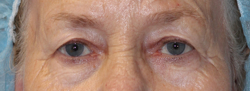 Blepharoplasty Before and After | PERK Plastic Surgery