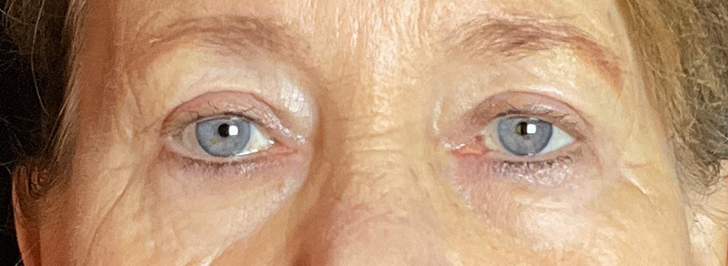 Blepharoplasty Before and After | PERK Plastic Surgery