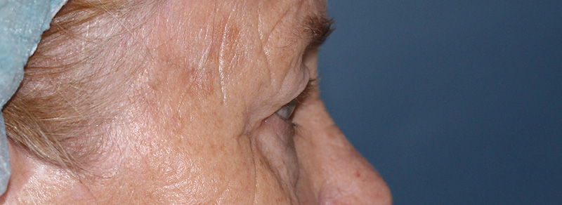 Blepharoplasty Before and After | PERK Plastic Surgery